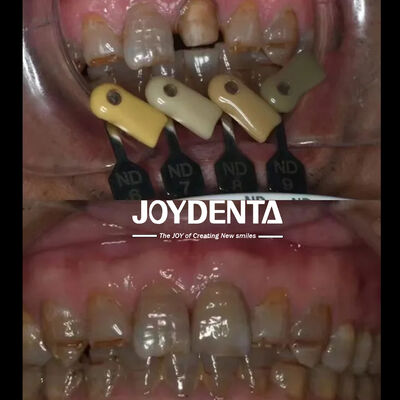 acheter Technologie de dégradation multicouche de couronnes de zirconia translucides fabrication en ligne