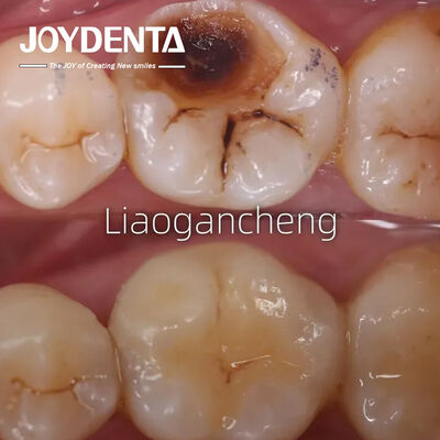 acheter Porcelaine Dental Inlay Restaurative Pour Adultes Et Enfants Performance exceptionnelle fabrication en ligne