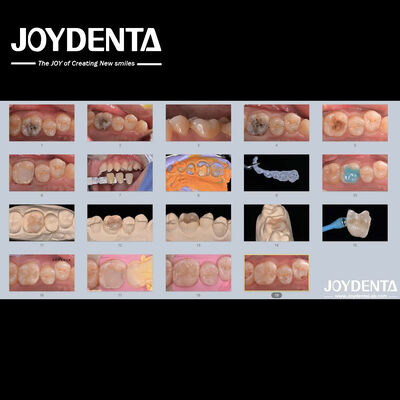 acheter Adultes Enfants Porcelaine en céramique en incrustation dentaire pour les dents endommagées fabrication en ligne