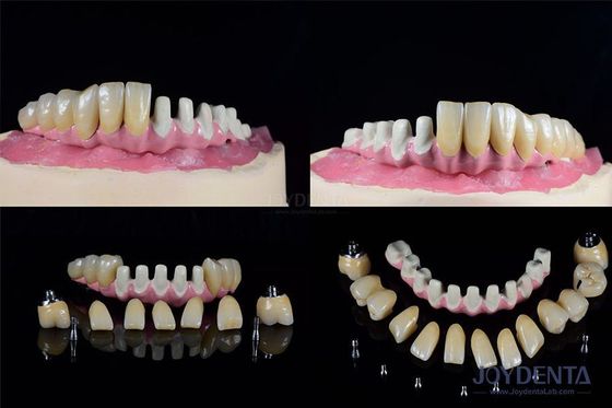 Implants dentaires endosseux multiples Connexion interne pour la restauration complète de l'arc