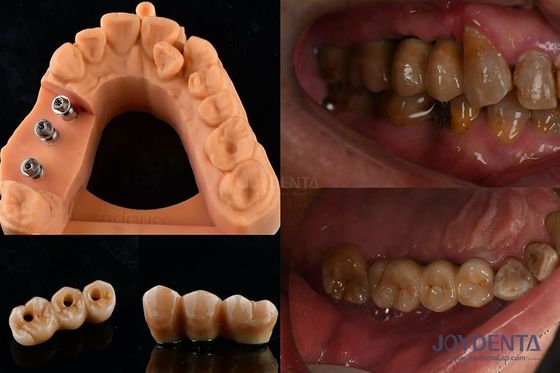 Stabilité de la couleur ultra-dure Couronne d'implant dentaire OEM Facile à entretenir Durable