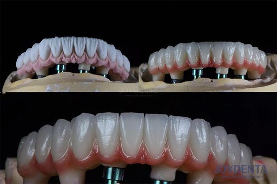 10 mm Dents multiples Deux étapes Kit d'implants dentaires pour la couronne prothétique endosseuse