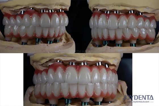 Implantation dentaire multiple en titane de 10 mm Surface rugueuse pour la restauration dentaire