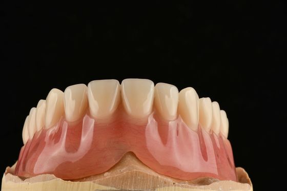 Une prothèse partielle amovible et réglable qui ressemble à des dents naturelles