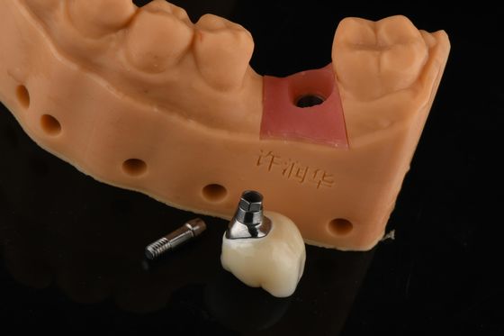 Précision cylindrique d'argent en remplacement d'une seule dent Implants de restauration dentaire
