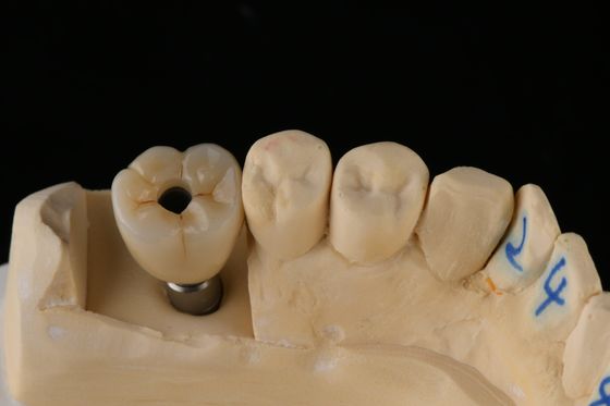 3Implant dentaire à vis en titane argenté de 75 mm. Implant de remplacement de dent unique