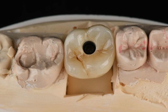 Titane 10 mm Implants dentaires à dent unique Remplacement d' abutment Autodécoupeur sablé