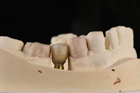 Implantation dentaire simple sablée avec fil d'autocollant et connexion hexagonale interne