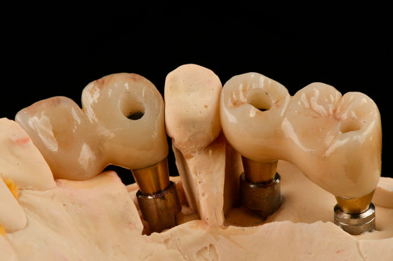 Auto-fonctionnement à fil de 3,0 mm Implantation dentaire en titane fonctionnalité optimisée