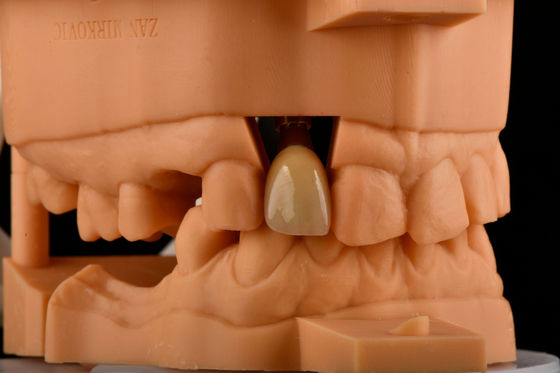 Remplacement d'implant dentaire en titane unique