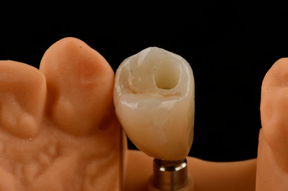 Implants dentaires à dent unique en titane Type de connexion hexagonale interne pour un ajustement optimal