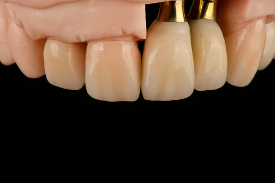Implant de remplacement de dent unique au sable de titane avec stérilisation par rayonnement gamma