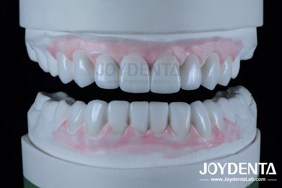 Régénérations dentaires très précises en dentisterie 1-2 mm d'épaisseur