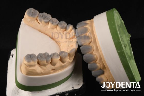 Dentistique temporaire de haute précision à cire personnalisée de 1 à 2 mm d'épaisseur