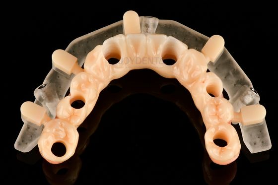 Modèles de chirurgie guidée imprimés 3D de précision personnalisés pour un placement précis des implants