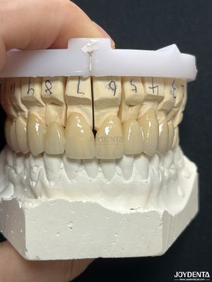 Une couronne métallique fondue en porcelaine PFM sans couture pour une restauration biocompatible à long terme