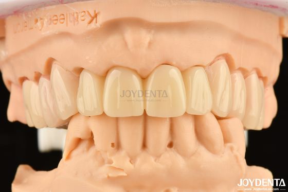 Biocompatible PMMA M75 Restoration Résistant aux rayures Pour l'esthétique dentaire