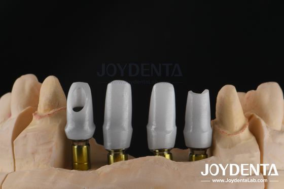 Implantation dentaire personnalisée à base de zirconium pour les restaurations d'unité unique ou multiple