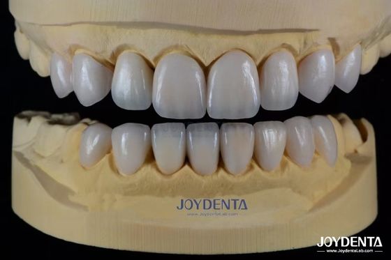 Porcelaine de céramique avancée, teinte biocompatible adaptée à un sourire naturel