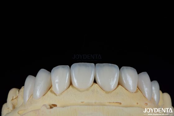 Veneurs dentaires durables et résistants aux taches avec des teintes personnalisées pour les dents naturelles