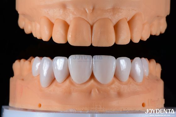 Porcelaine sécurisée, placage en céramique, esthétique naturelle et forte adhérence