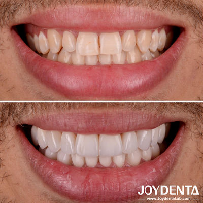 Parfaitement adapté Porcelaine Veneers dentaires Transparence naturelle Veneers dentaires stratifiés