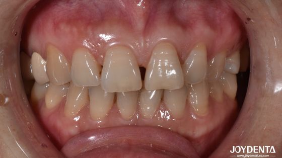 0Épaisseur de.5 mm Faisceaux dentaires en céramique naturels à la recherche d'indications sur les dents antérieures