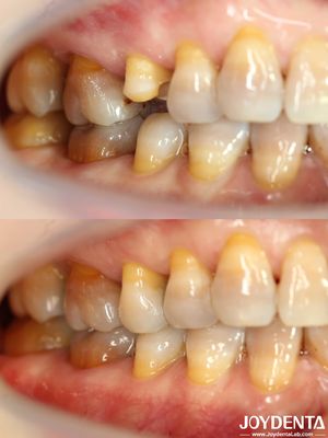 Personnalisable Inlay dentaire abordable Restaurative Précisément adapté pour les dents endommagées