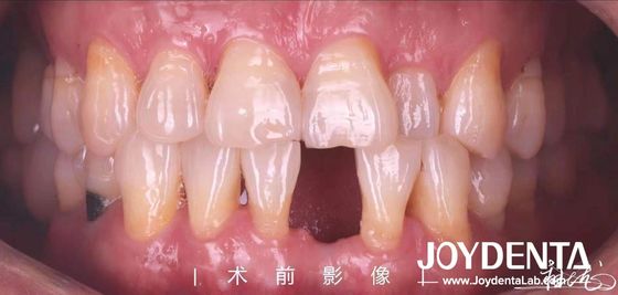 Des ponts en résine Maryland personnalisables pour les dents antérieures et prémolaires