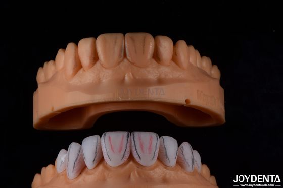 Veneurs en céramique Emax sur mesure pour les soins dentaires, résistant aux taches et très brillant