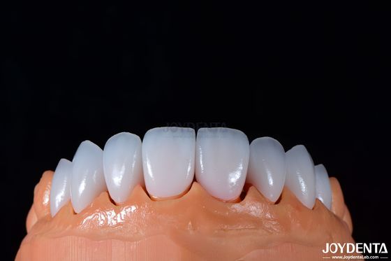 0.3-0.5 mm Épaisseur Émax Porcelaine Veneer pour la dentisterie cosmétique haute brillance