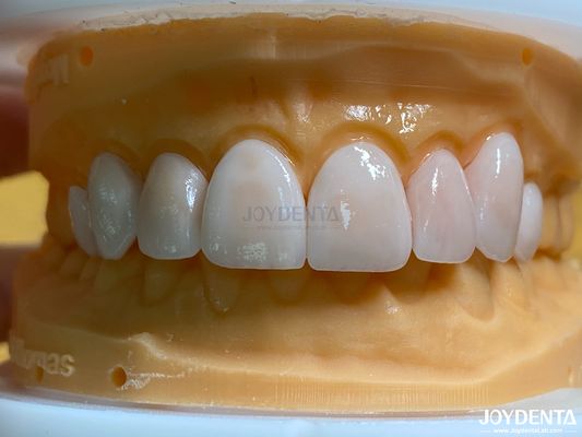 Faisceaux à haute perméabilité à l'aspect naturel Faisceaux en porcelaine Emax personnalisés