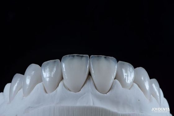 L'apparence naturelle de la facette en porcelaine Emax est confortable, adaptée aux facettes émax ultra fines
