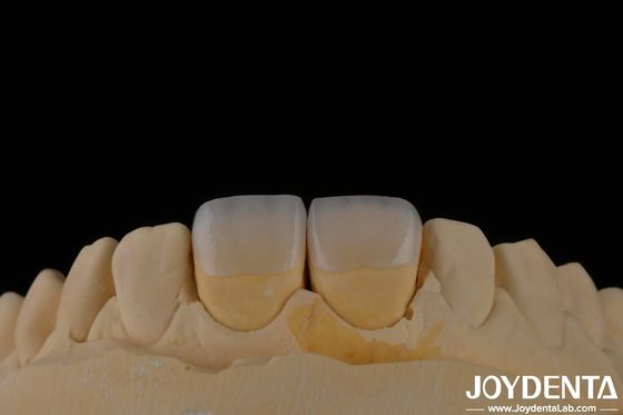 Dentistique à longue durée de vie Faisceau feldspathique Couleur des dents naturelles Apparence translucide