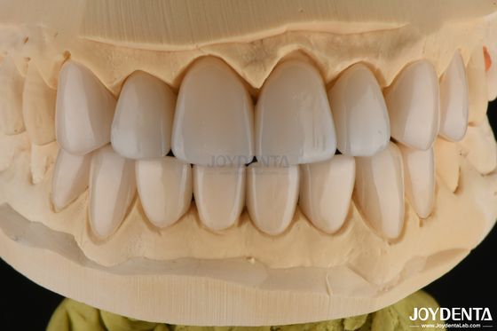 0.3-0.5mm Épaisseur de placage de porcelaine feldspathique haute résistance aux fractures Améliorer votre sourire