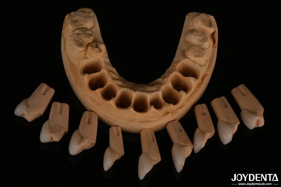 Finition dentaire feldspathique très naturelle avec une surface brillante