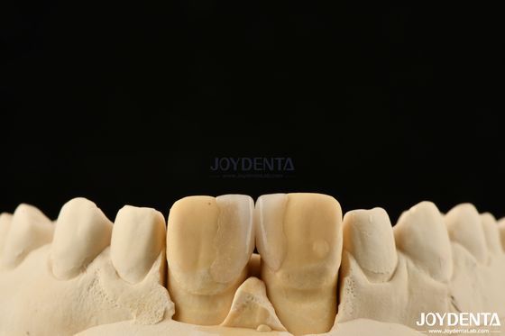 0Épaisseur de.2 mm Veneurs à microthines Veneurs dentaires en verre céramique pour les dents avant
