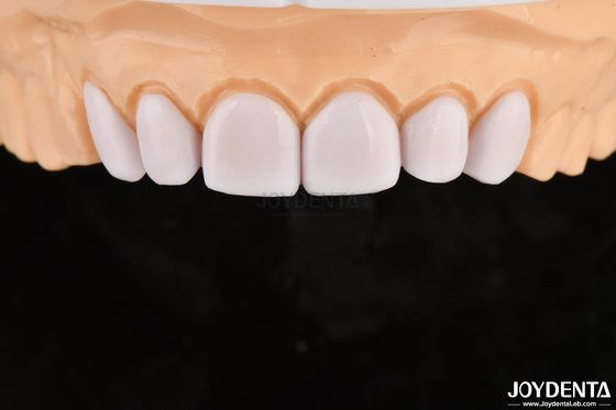 Veneurs dentaires en verre céramique pour blanchiment des dents