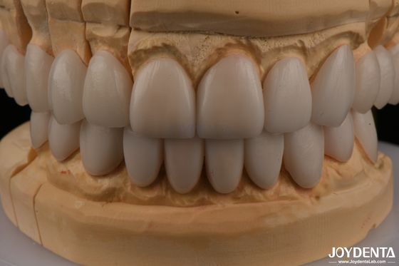 0.3 mm Épaisseur Ips Émax Faisceaux Faisceaux céramiques Anterior Posterior Restaurations