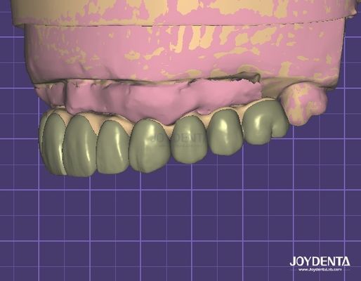 Sécurité des données conforme à la norme HIPAA Modèle 3D numérique pour les modifications dentaires