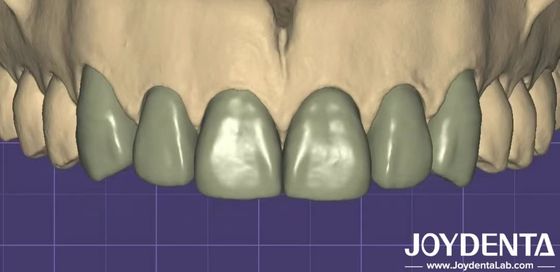 Impression 3D Virtual Digital Wax Up Compatibilité avec les autres logiciels dentaires