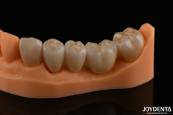 Restaurations dentaires de précision Zirconium complet Résistance à la flexion élevée Couleur naturelle
