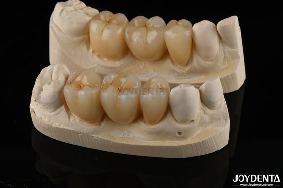 Résistant à l'usure Zirconia à contour complet Couronne dentaire haute translucide