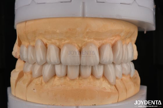 Zirconia à couche translucide pour les restaurations dentaires à contour complet
