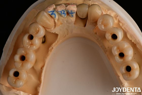 Circonia à contour complet multicouche à haute translucide à l'aspect naturel 1200 HV