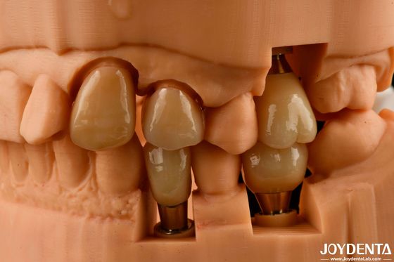 Une couronne et un pont d'implant personnalisables donnent un aspect naturel et des résultats durables