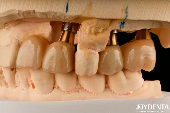 Restauration des dents manquantes Implantation couronne et pont sans danger pour l'oral avec un ajustement précis