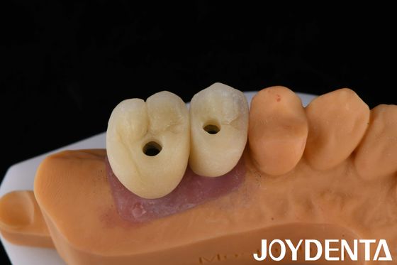 La couronne et le pont d'implant de porcelaine sont la solution ultime pour restaurer les dents manquantes.