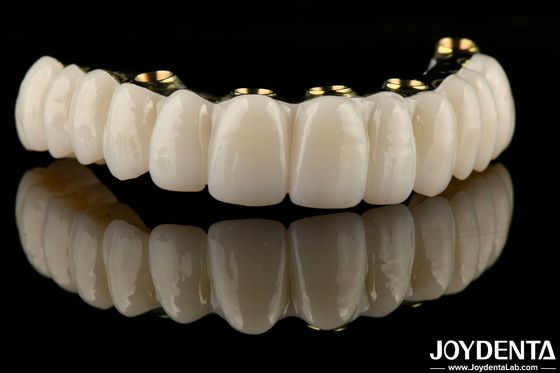 Pont d'implant en zirconium hybride lisse rétablissant la fonction de mastication sur mesure