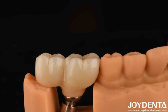 Type de fil en forme de V Abutments finis Compatibilité avec tous les principaux systèmes d'implants